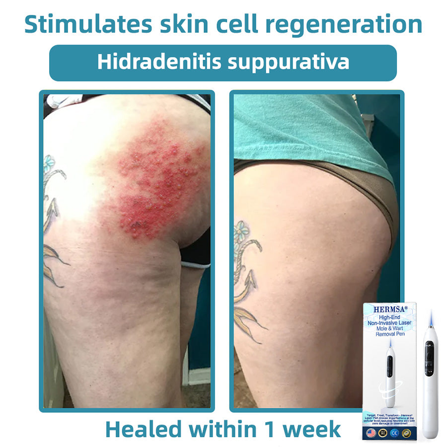 Hermsa® High-End Non-Invasive Laser Mole & Wart Removal Pen